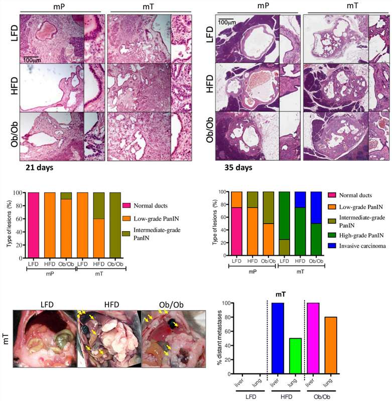 Fig.1 Diet- and genetic- induced obesity accelerate pancreatic tumor growth, PanIN lesion evolution, and metastasis in syngeneic organoid-transplant models. (Lupo, et al. , 2020)