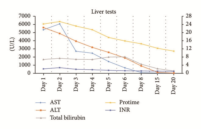 Fig.1 Line graph titled 'Liver tests' showing changes in key liver function markers (AST, ALT, Protime, INR, Total bilirubin) from Day 1 to Day 20 of hospitalization: On Day 1 (after 4 weeks of Garcinia cambogia use), markers like AST (~5340 U/L) and ALT (~5615 U/L) are severely elevated; all metrics steadily decline to normal levels by Day 20, demonstrating liver recovery post-discontinuation of the weight loss supplement (visual evidence of Garcinia cambogia-induced hepatotoxicity). (Kothadia, et al., 2018)